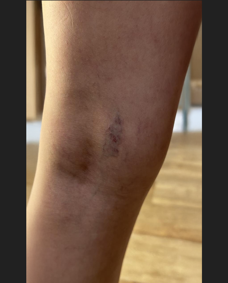 01 - VARIZES - ANTES