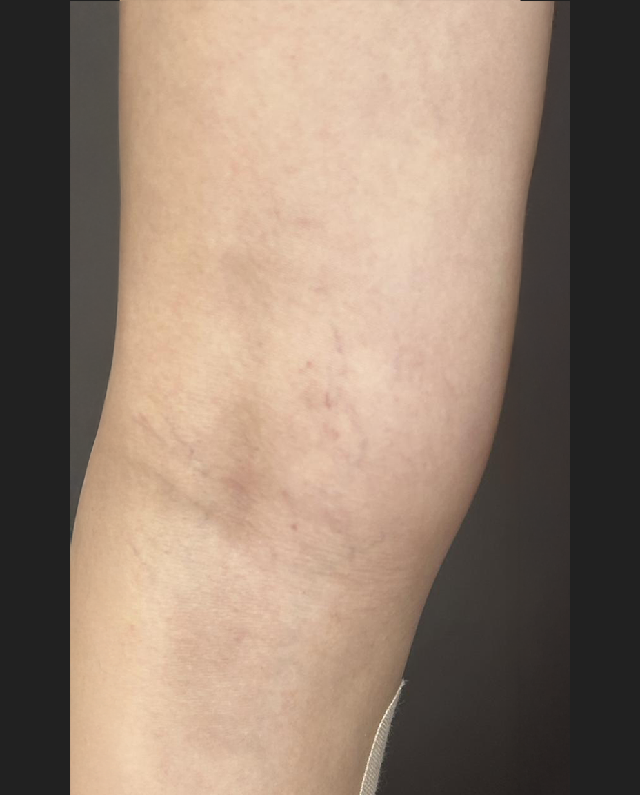 01 - VARIZES - DEPOIS