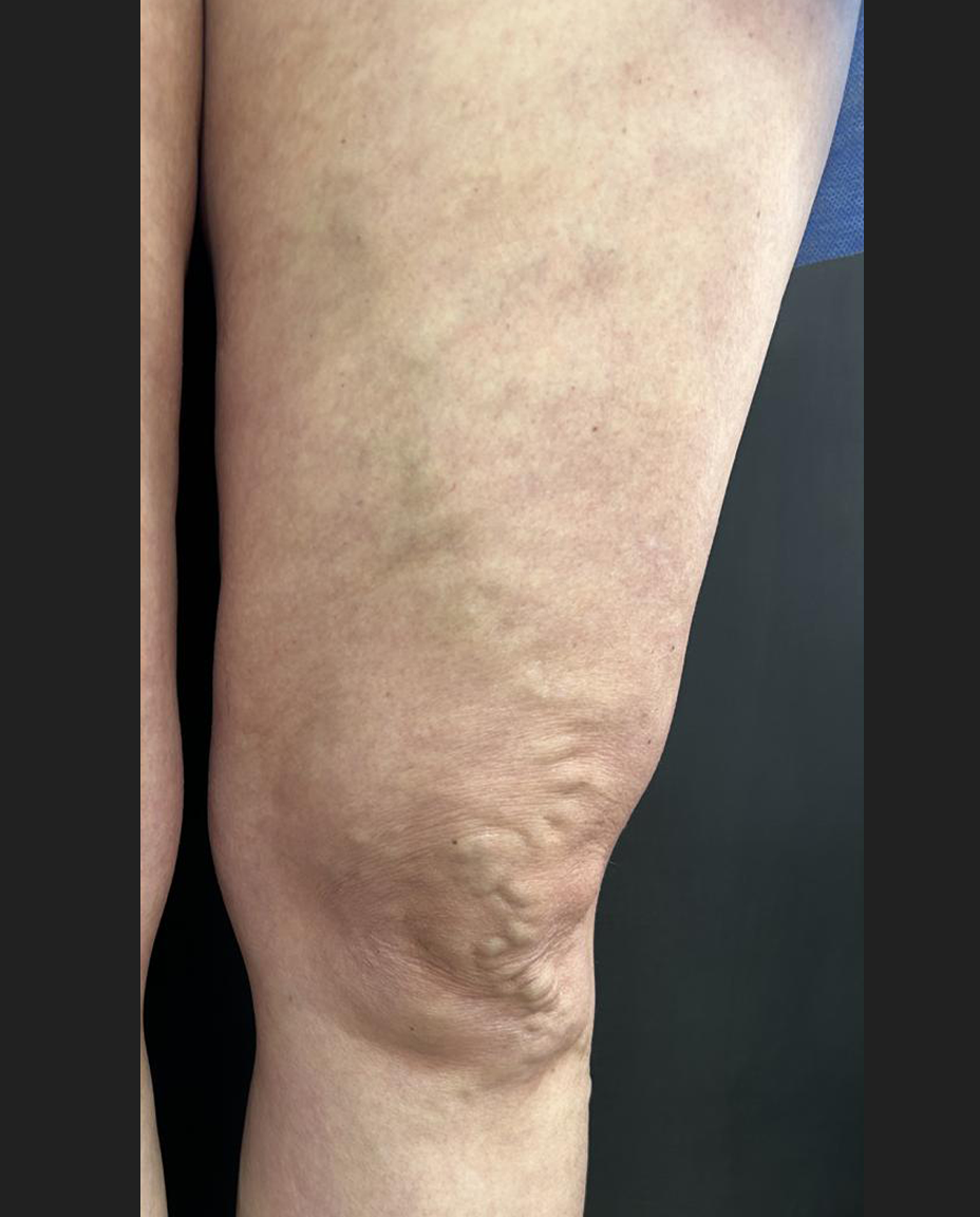 02 - VARIZES - ANTES