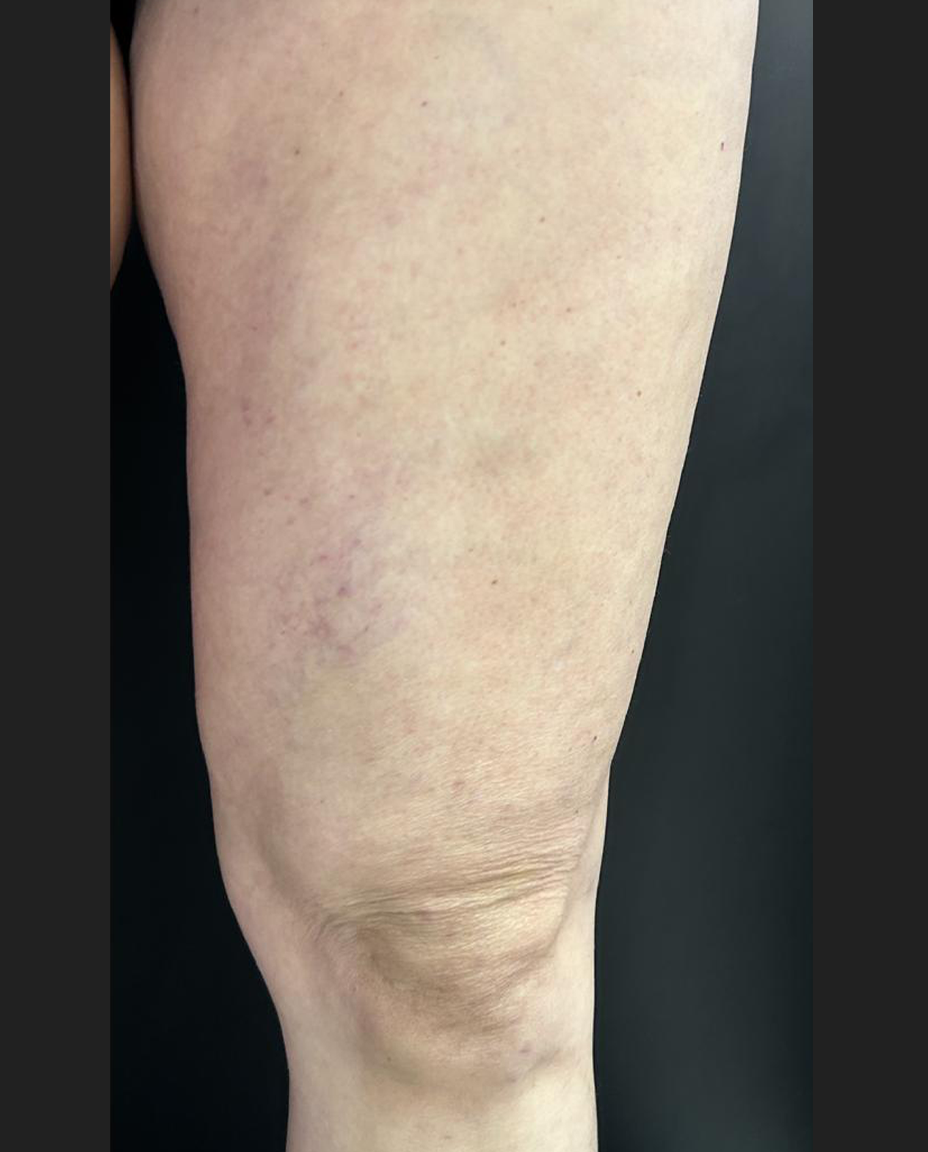 02 - VARIZES - DEPOIS