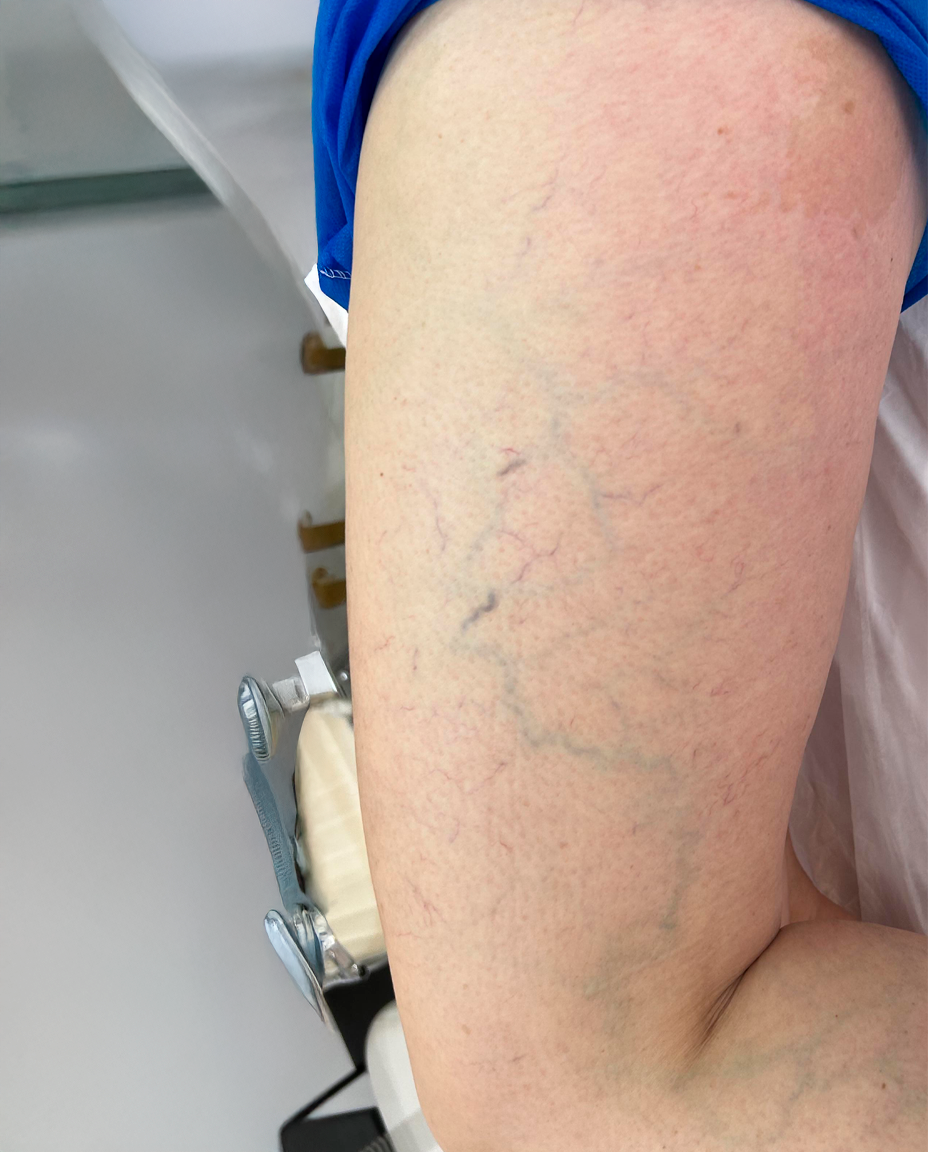 04 - VARIZES - ANTES