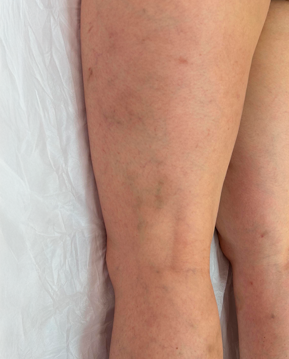 05 - VARIZES - DEPOIS