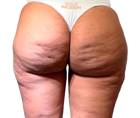 Antes do tratamento GoldIncision®: região glútea, vista posterior