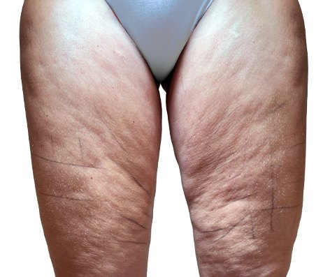Antes do tratamento GoldIncision®: coxas, vista posterior