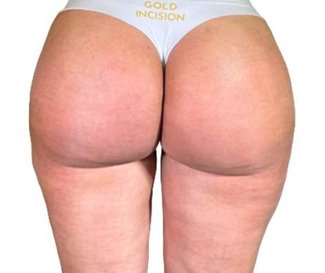 Depois do tratamento GoldIncision®: região glútea, vista posterior