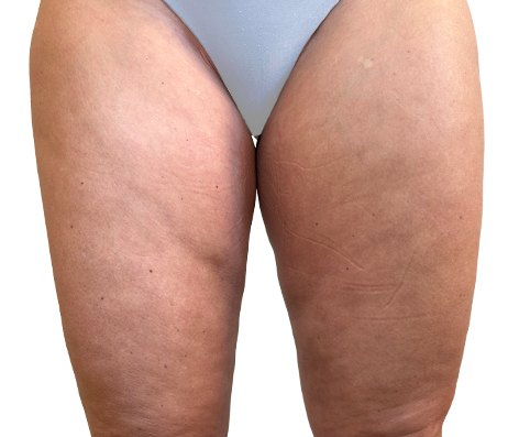 Depois do tratamento GoldIncision®: coxas, vista posterior