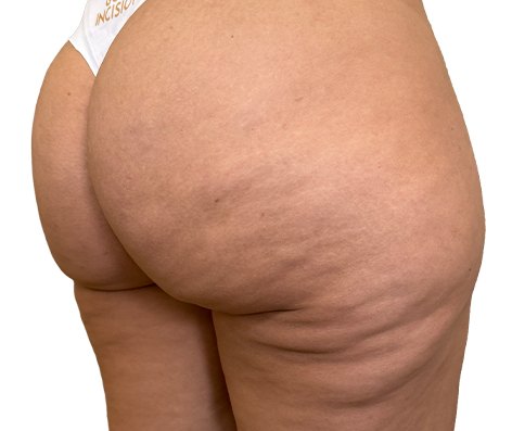 Depois do tratamento GoldIncision®: região glútea, vista oblíqua